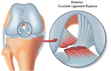 Tiêu chí đánh giá quá trình phục hồi Dây chằng chéo trước – ACL